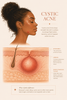 How Do I Treat Cystic Acne at Home?