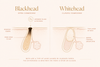 What Is The Difference Between Whiteheads And Blackheads?