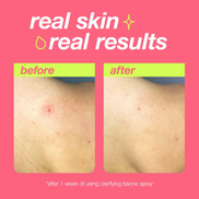 Clarifying Bacne Spray