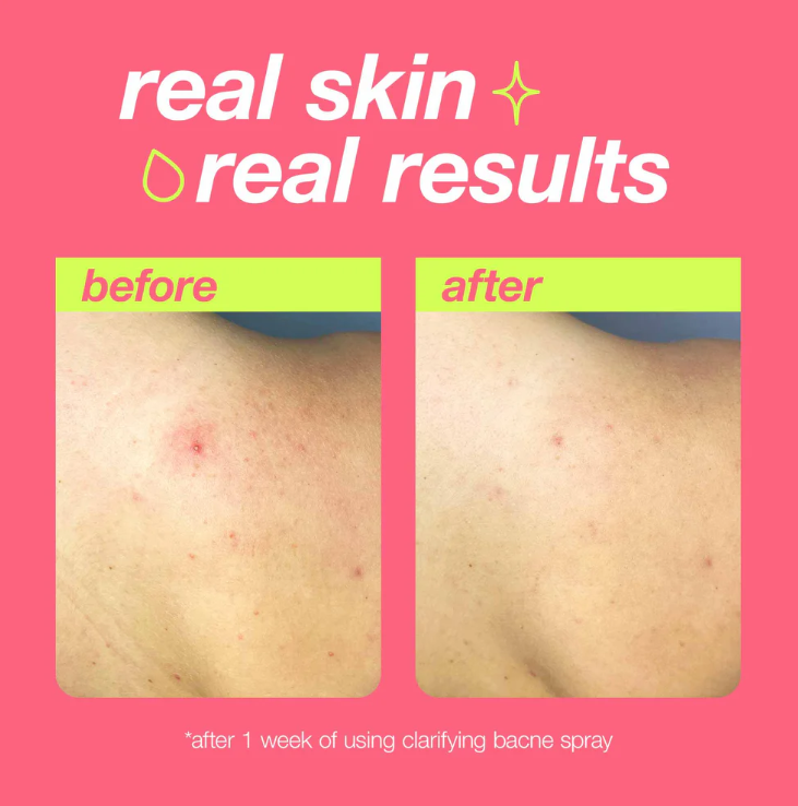 Clarifying Bacne Spray