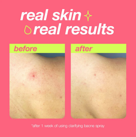 Clarifying Bacne Spray