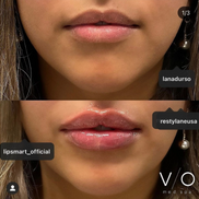 LipSmart