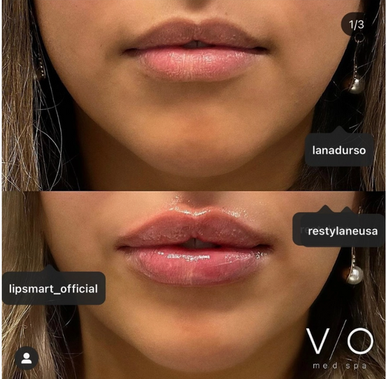 LipSmart